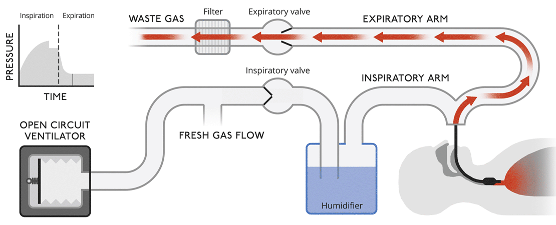This is a very simple version of a ventilator where waste gas is expelled from the system without recycling.